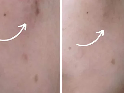 مجموعة العناية الطبيعية للبشرة الدهنية 